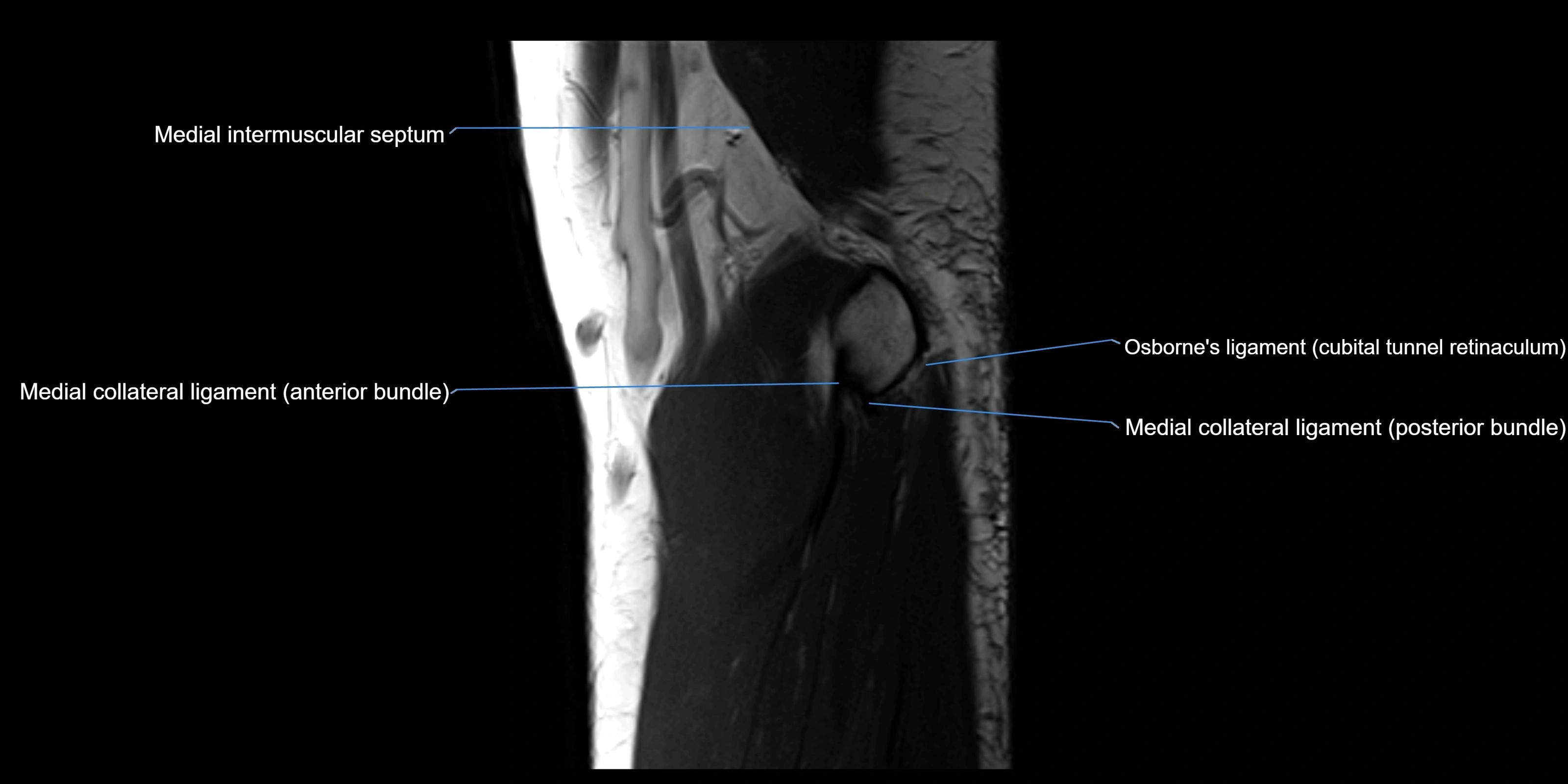 MRI elbow sagittal cross sectional anatomy 3T radiology  image-img-00001-00008.webp